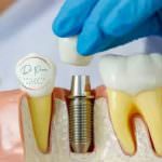 Group logo of Replacing Crowns & Bridges with Implants: A Paradigm Shift in Dental Restoration